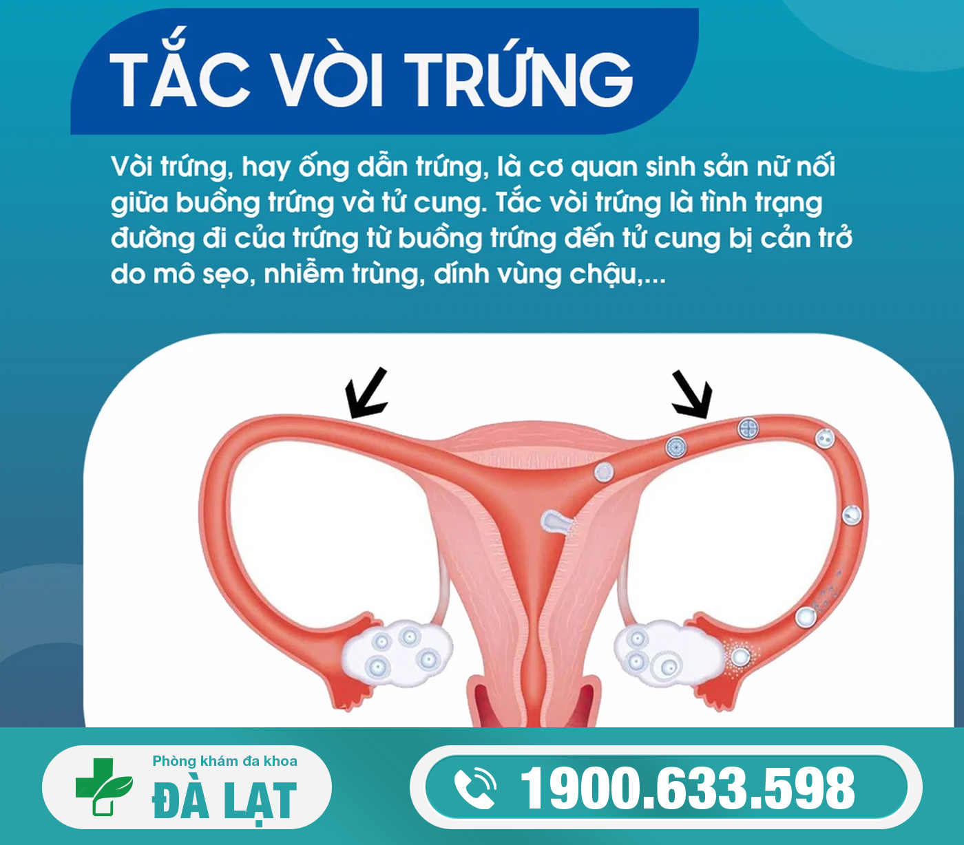 VÔ SINH NỮ GIỚI? CÁCH ĐIỀU TRỊ HIỆU QUẢ?