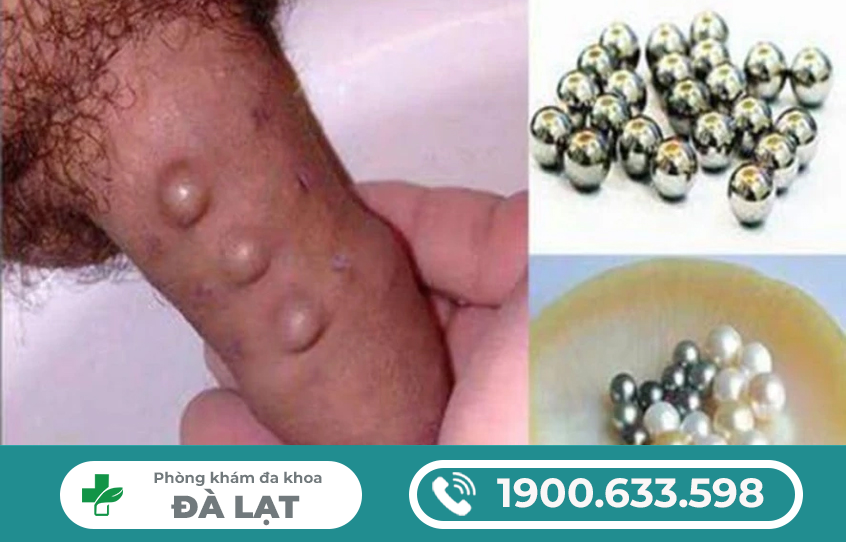 CÁCH GẮN BI DƯƠNG VẬT HIỆU QUẢ, AN TOÀN.
