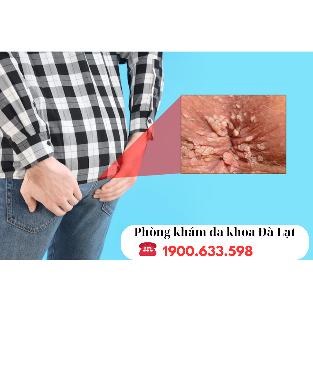 Mụn cơm ở hậu môn là gì? Mụn cơm hậu môn có nguy hiểm không?