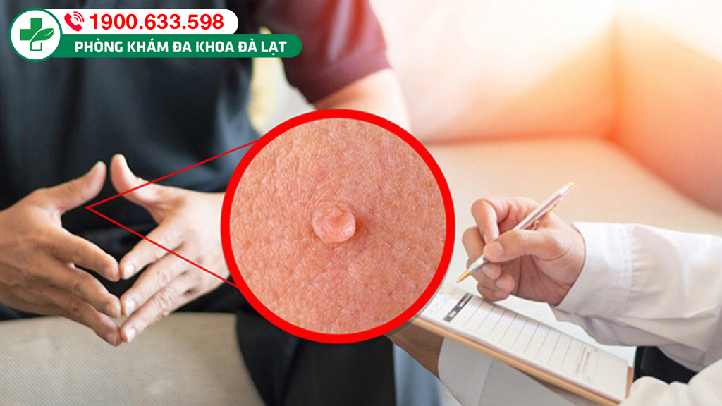 NGUYÊN NHÂN DƯƠNG VẬT NỔI MỤN LITI VÀ CÁCH ĐIỀU TRỊ