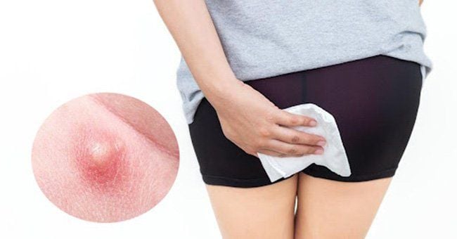 Mụn trắng ở hậu môn: Những điều cần biết và cách điều trị