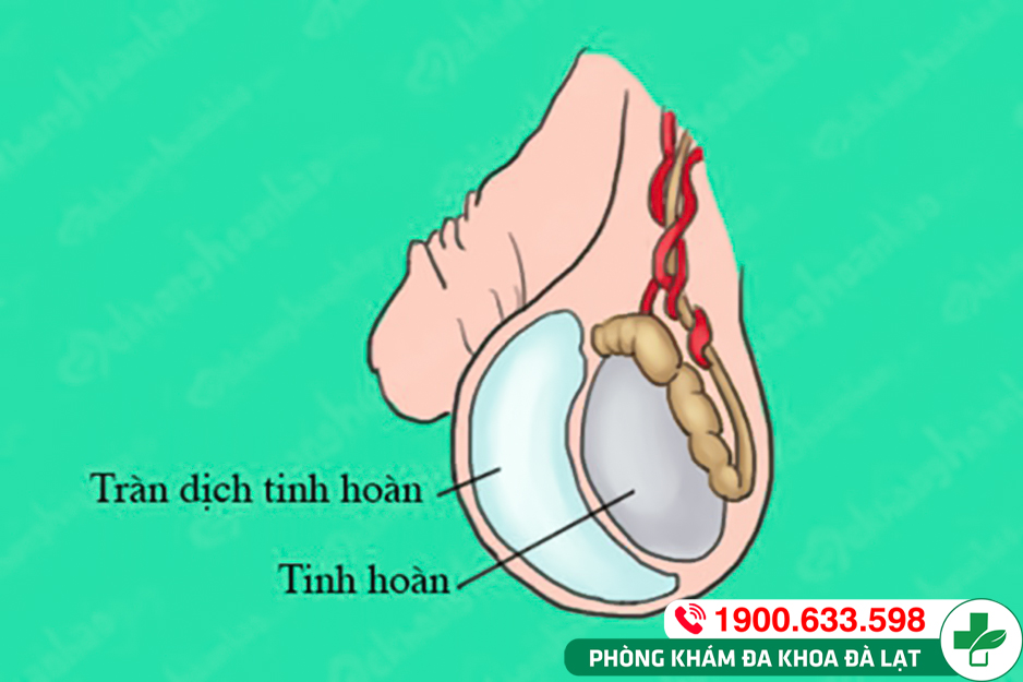 TRÀN DỊCH MÀNG TINH HOÀN