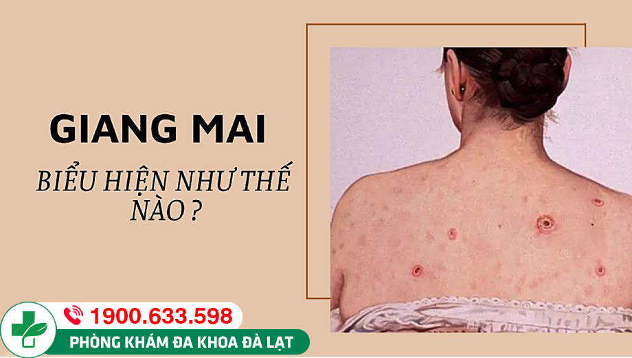 BIỂU HIỆN BỆNH GIANG MAI: CẢNH BÁO SỨC KHỎE KHÔNG THỂ BỎ QUA