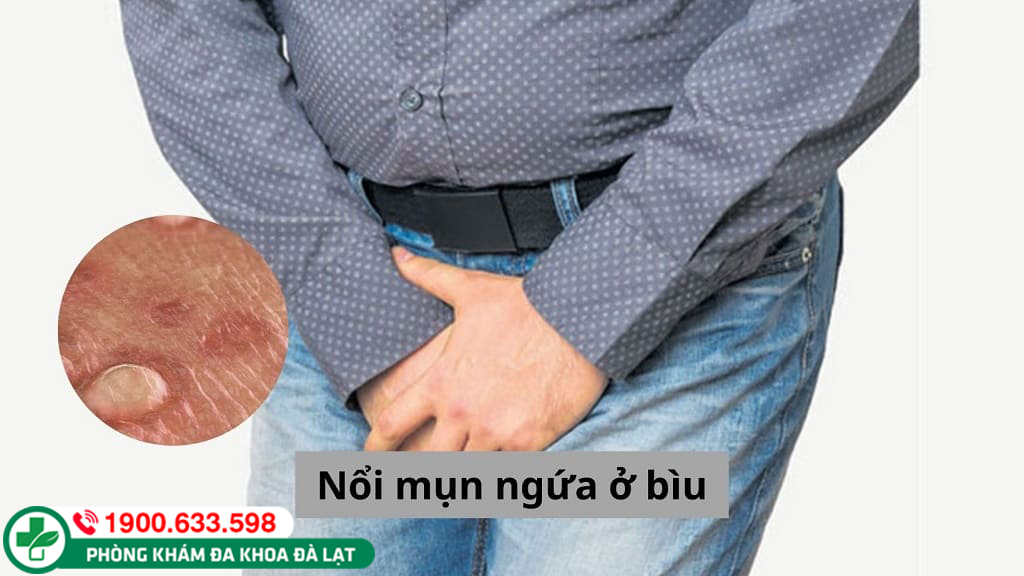 MỤN BÌU TINH HOÀN LÀ TRIỆU CHỨNG CỦA BỆNH GÌ? CÁCH ĐIỀU TRỊ RA SAO