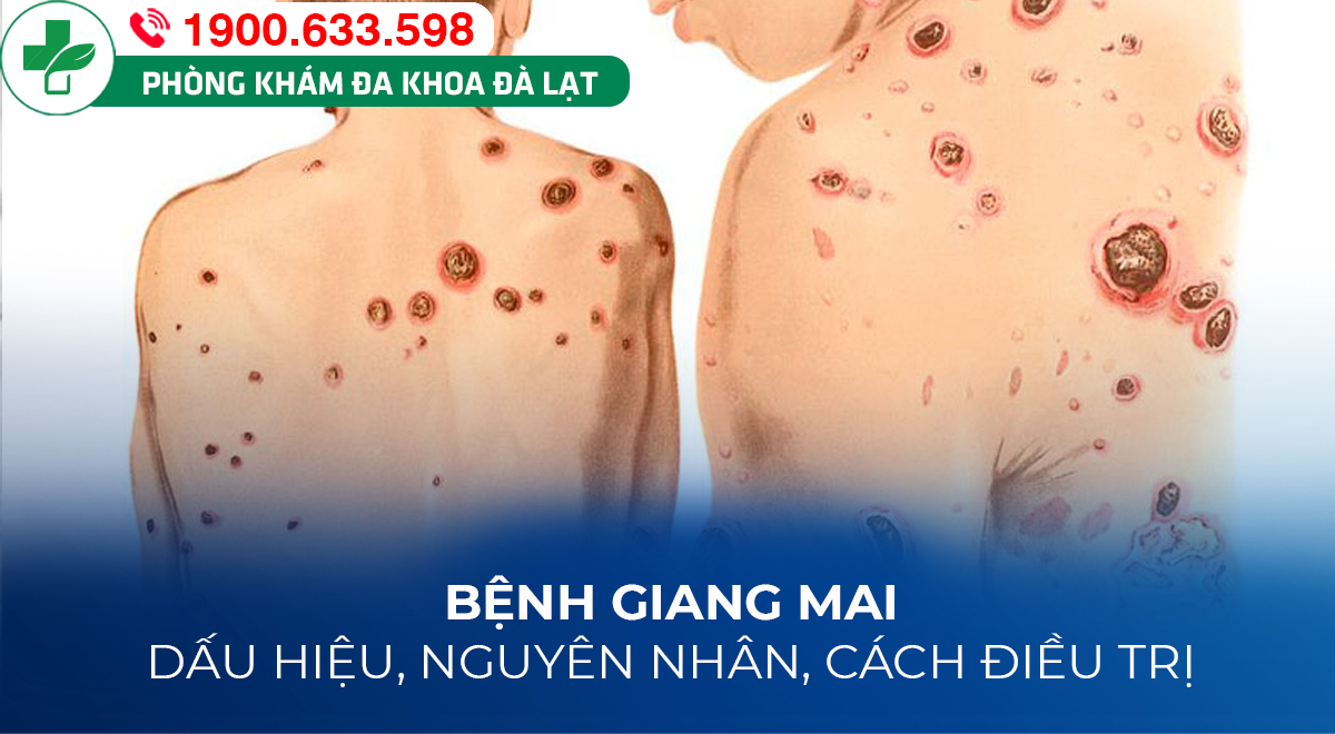 NGUYÊN NHÂN GÂY NÊN BỆNH GIANG MAI