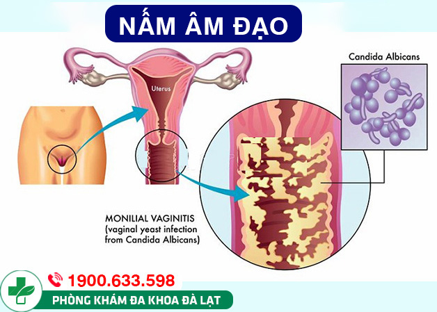 Bị nấm âm đạo có nguy hiểm gì không?