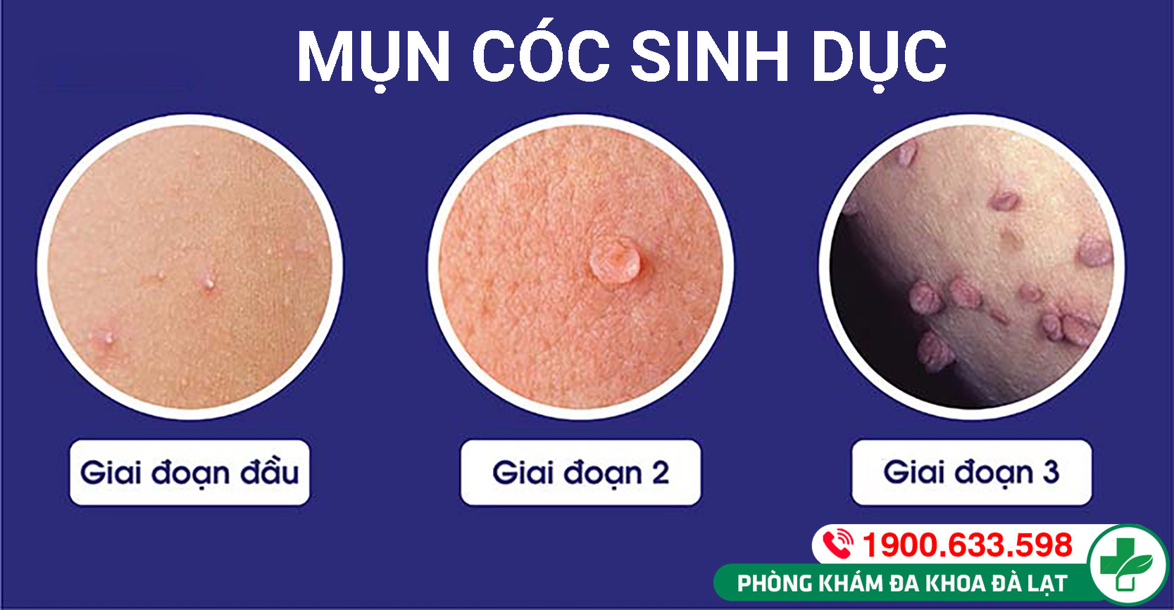 DẤU HIỆU NHẬN BIẾT DƯƠNG VẬT MỌC MỤN CÓC VÀ PHƯƠNG PHÁP ĐIỀU TRỊ