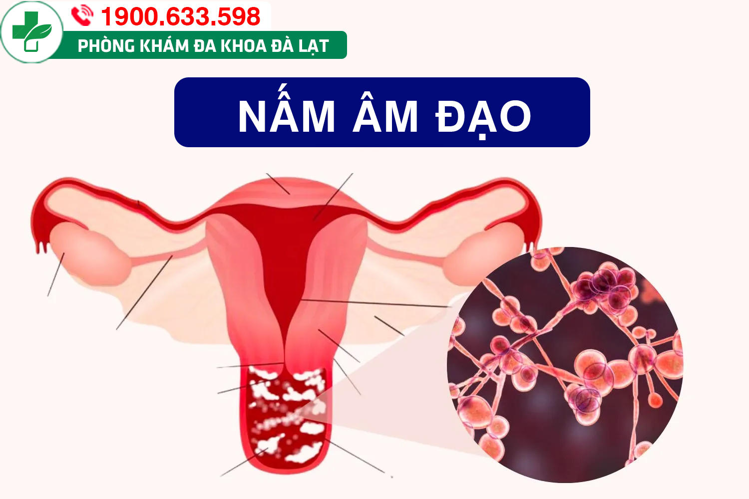 Cách điều trị khi bị nhiễm nấm âm đạo