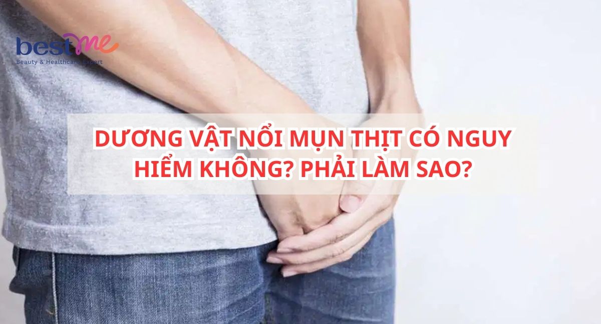 DƯƠNG VẬT NỔI MỤN THỊT: NHỮNG THÔNG TIN QUAN TRỌNG NAM GIỚI CẦN BIẾT