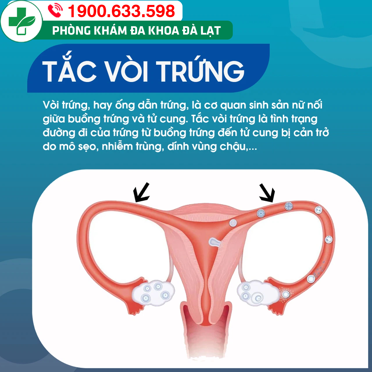 Chuyên gia giải đáp: Thông tắc vòi trứng ở đâu tốt nhất?