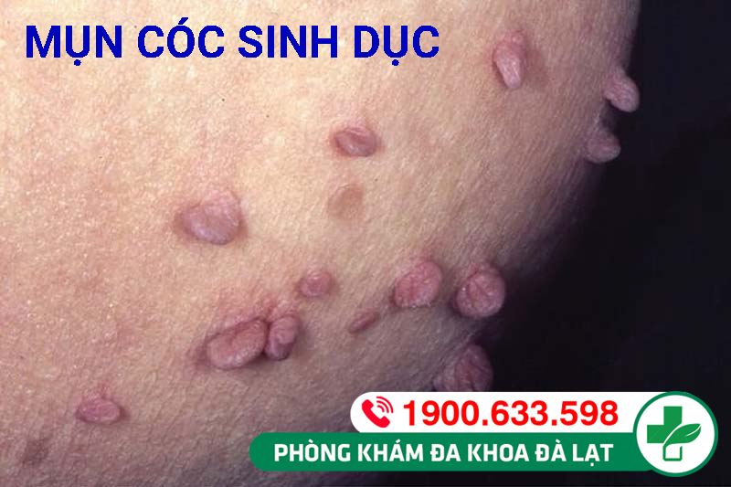 Mụn cóc sinh dục có lây không?
