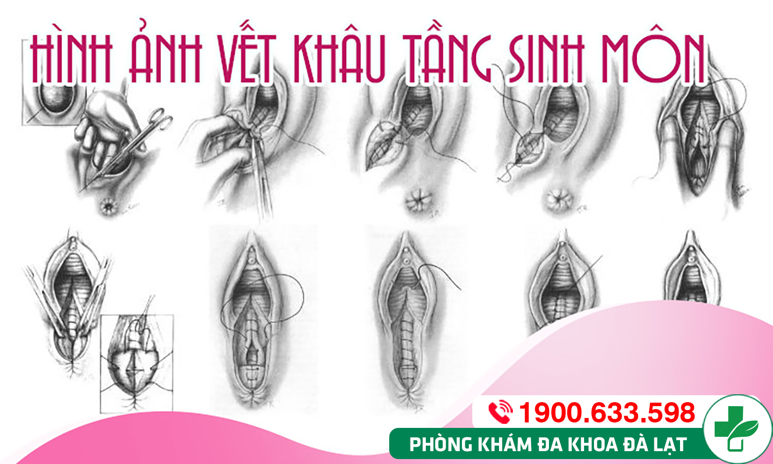  Thẩm mỹ âm đạo - Tầng sinh môn