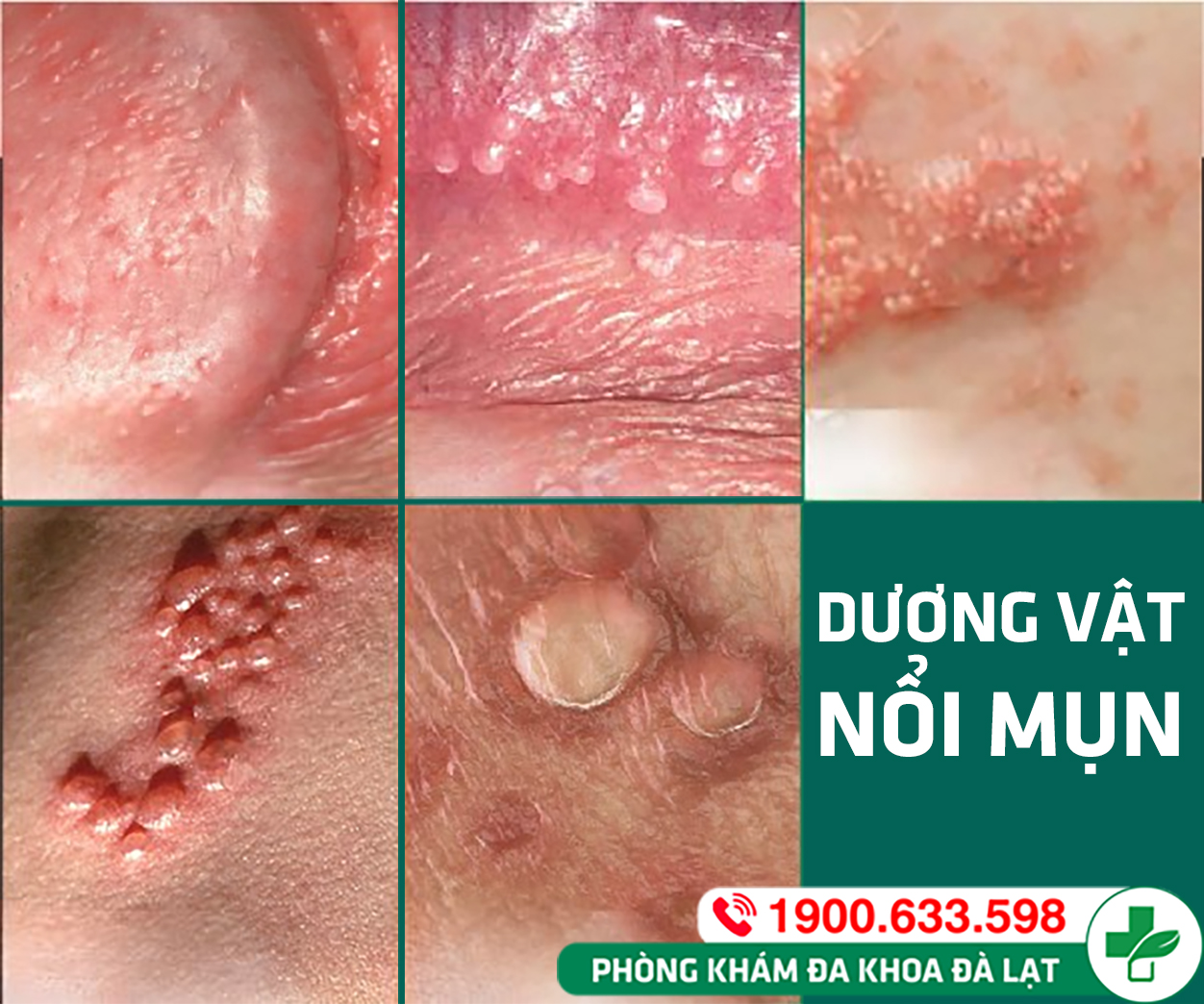 Dương vật nổi mụn: Nguyên nhân, cách điều trị