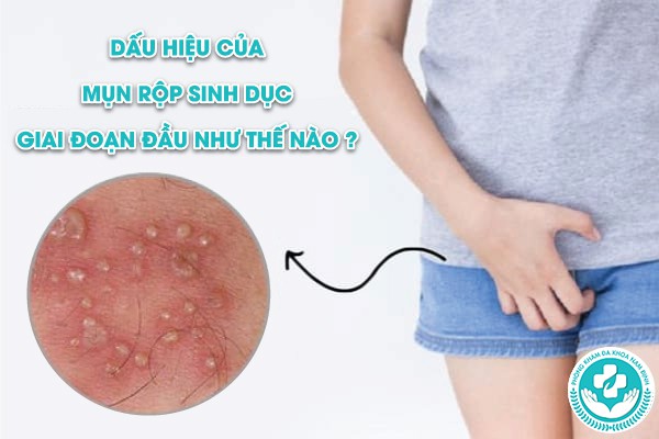 MỤN RỘP HERPES SINH DỤC VÀ CÁCH CHỮA
