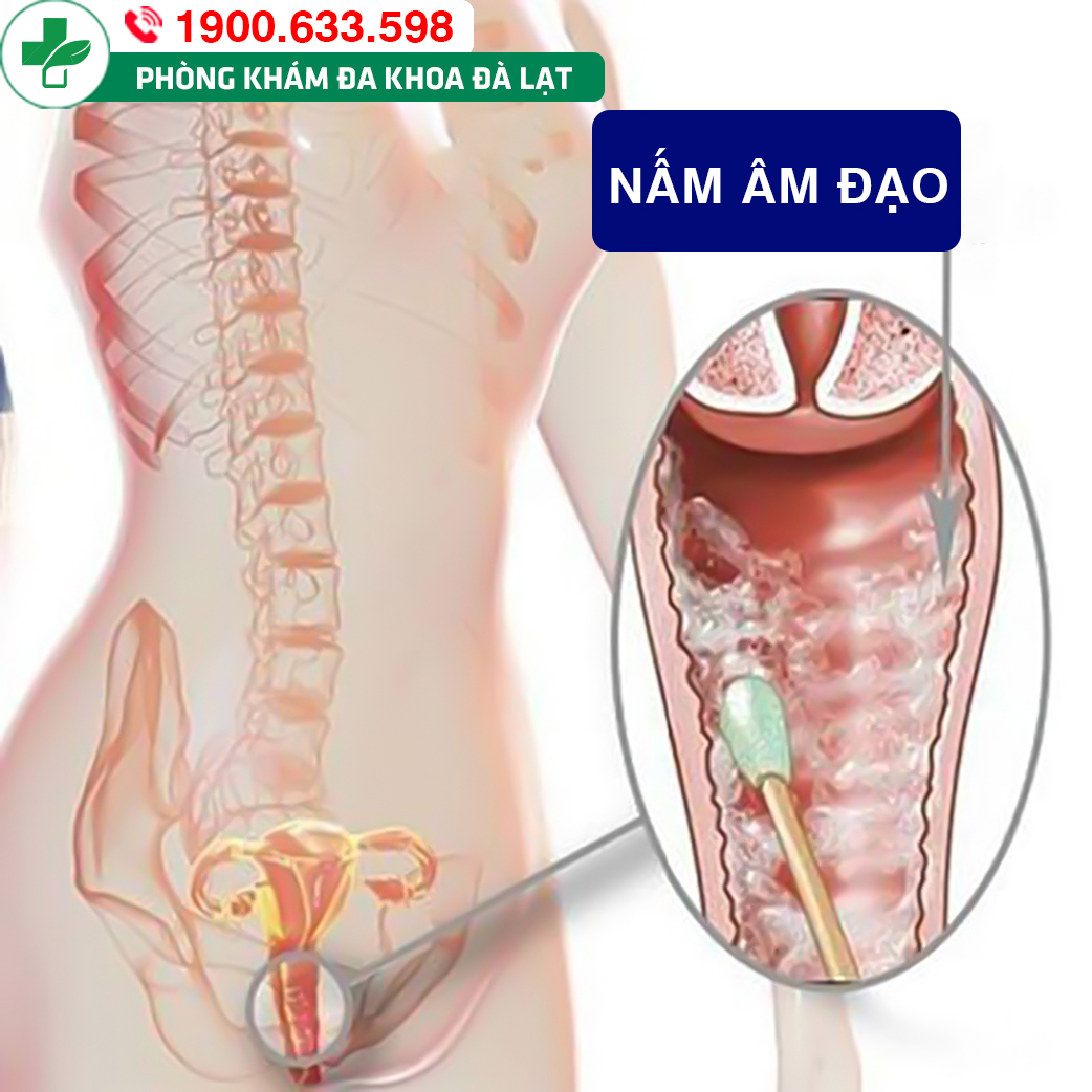 Nấm âm đạo: Triệu chứng và cách điều trị