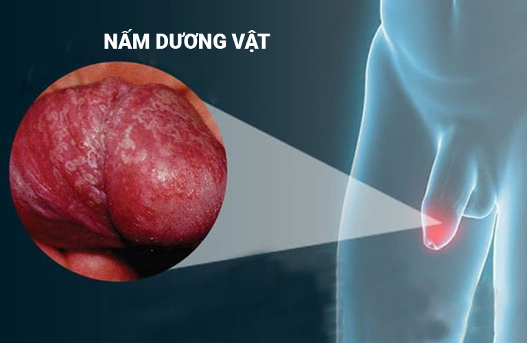 NẤM DƯƠNG VẬT CÓ NGUY HIỂM KHÔNG? BIỂU HIỆN, NGUYÊN NHÂN VÀ ĐỊA CHỈ ĐIỀU TRỊ