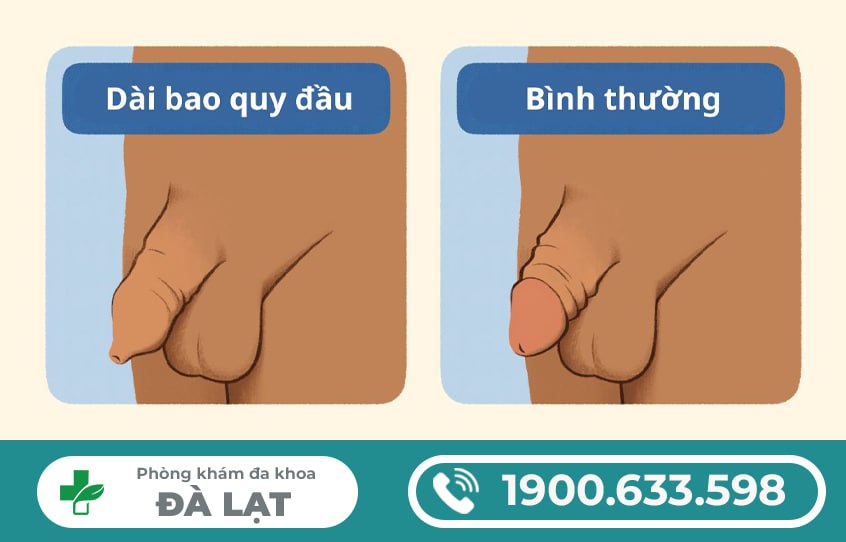 CÁCH NHẬN BIẾT DÀI BAO QUY ĐẦU Ở NAM GIỚI