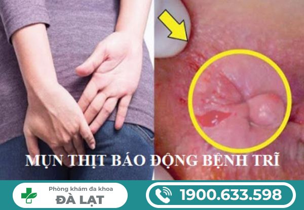 Nổi mụn ở hậu môn là dấu hiệu của bệnh lý nguy hiểm nào?