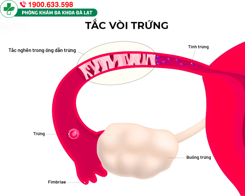 TẮC VÒI TRỨNG LÀ GÌ? PHƯƠNG PHÁP ĐIỀU TRỊ HIỆU QUẢ