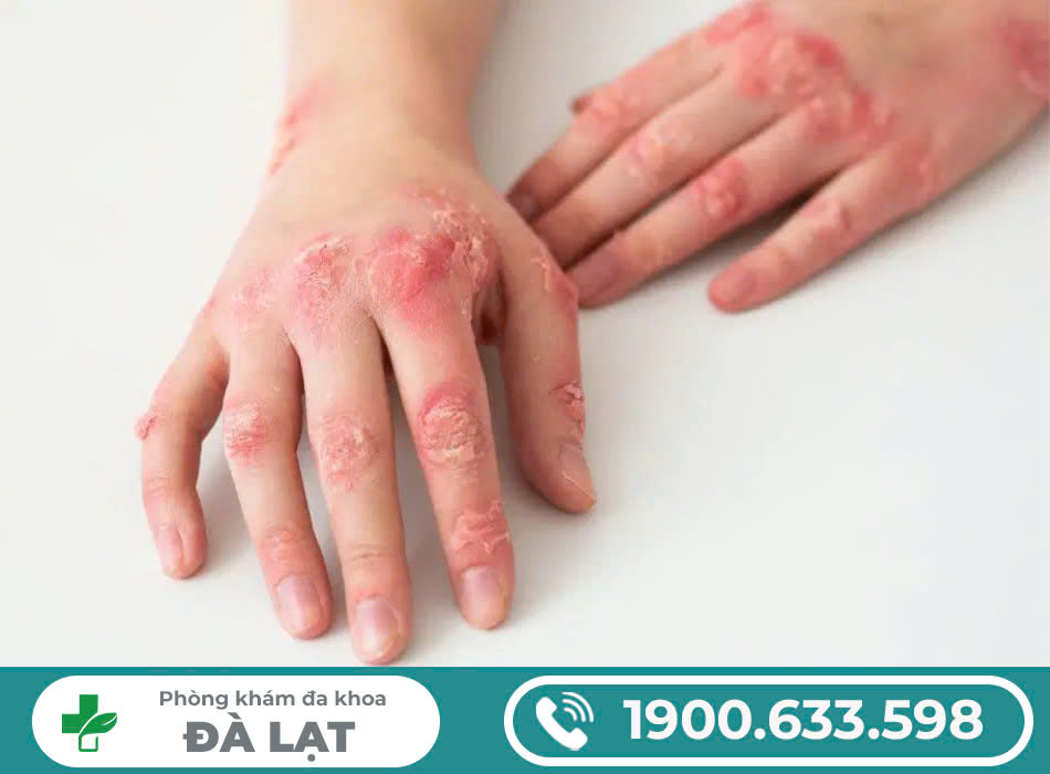 TÌM HIỂU VỀ BỆNH GIANG MAI Ở CẢ 2 GIỚI 
