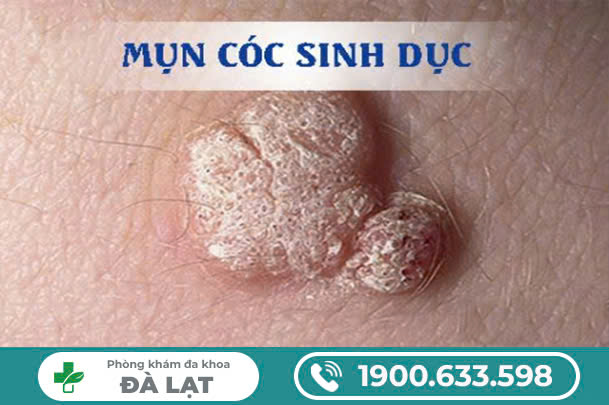 BỊ MỤN CÓC Ở VÙNG KÍN