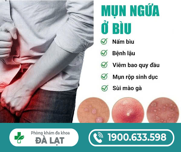MỤN NGỨA Ở BÌU