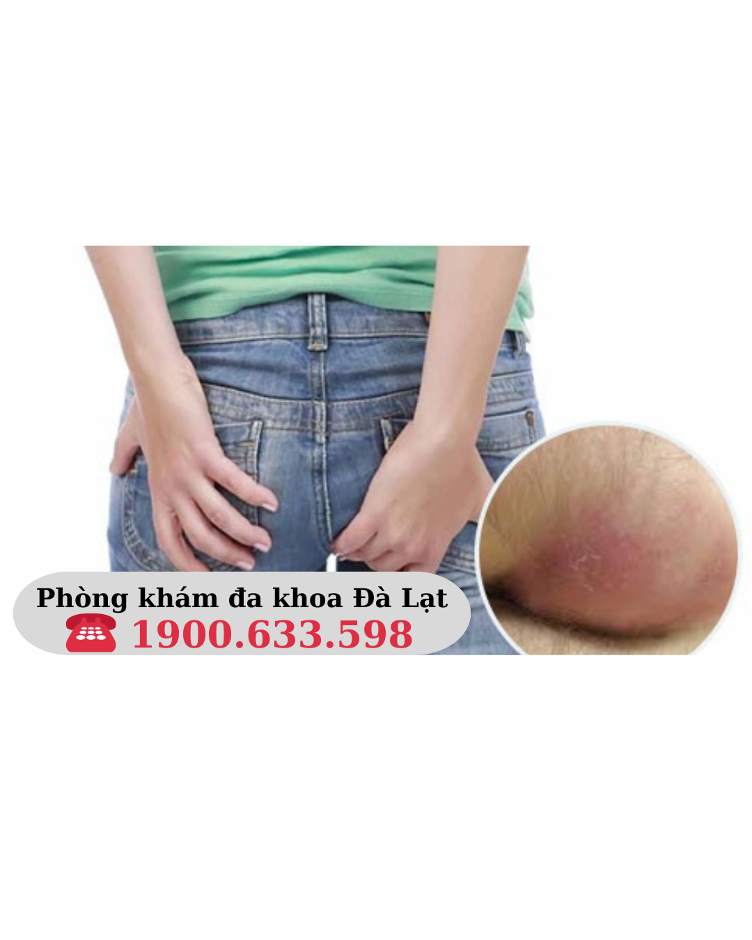 MỤN CỨNG Ở HẬU MÔN: NGUYÊN NHÂN VÀ PHƯƠNG PHÁP ĐIỀU TRỊ
