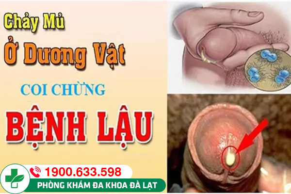 Bệnh lậu chảy mủ là gì? Nguyên nhân và các dấu hiệu cảnh báo