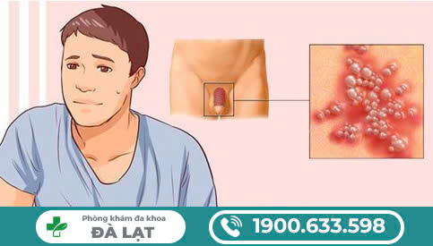 MỤN SINH DỤC Ở VÙNG KÍN NAM LÀ GÌ?