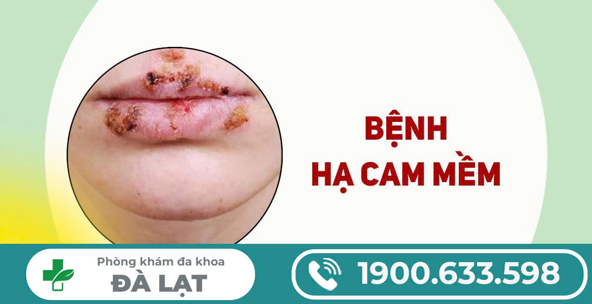 Bệnh Hạ Cam Mềm Là Gì? Điều Trị Hiệu Quả Tại Phòng Khám Đa Khoa Đà Lạt
