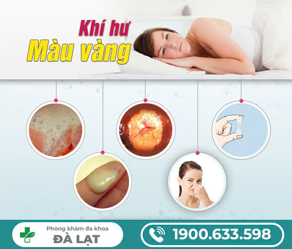 Khí hư màu vàng như mủ là dấu hiệu bệnh gì?