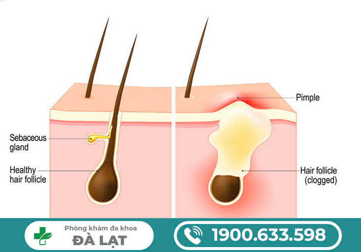 MỌC MỤN TRỨNG CÁ Ở VÙNG KÍN NAM