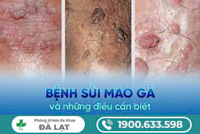 phân biệt về nốt sùi mào gà màu đen, màu trắng