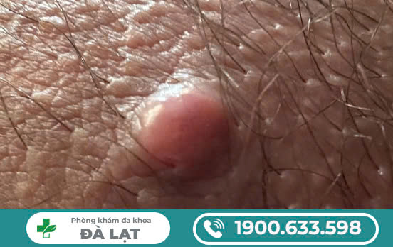 Mụn Áp Xe Ở Vùng Kín – Nguyên Nhân và Cách Điều Trị Hiệu Quả Tại Phòng Khám Đa Khoa Đà Lạt