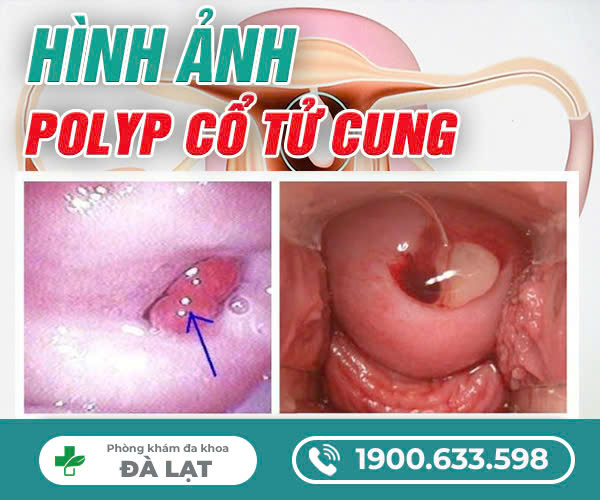 HÌNH ẢNH BỆNH POLYP CỔ TỬ CUNG