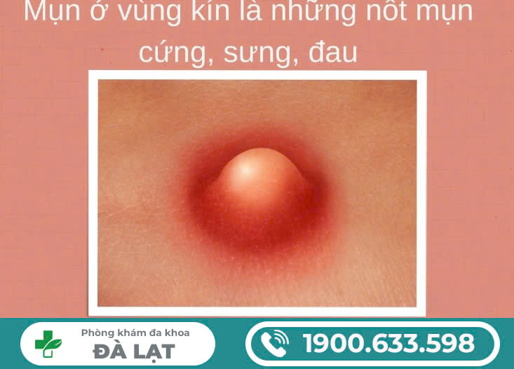 MỌC MỤN MỦ Ở VÙNG KÍN NAM GIỚI