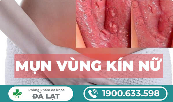 Tại sao cô bé bị nổi mụn ?