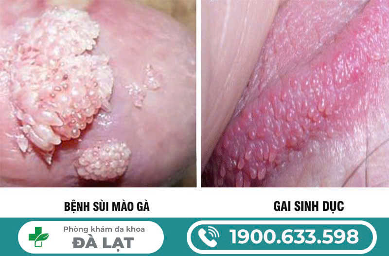 SÙI MÀO GÀ Ở NIỆU ĐẠO NAM VÀ NỮ GIỚI? PHƯƠNG PHÁP ĐIỀU TRỊ HIỆU QUẢ NHẤT!