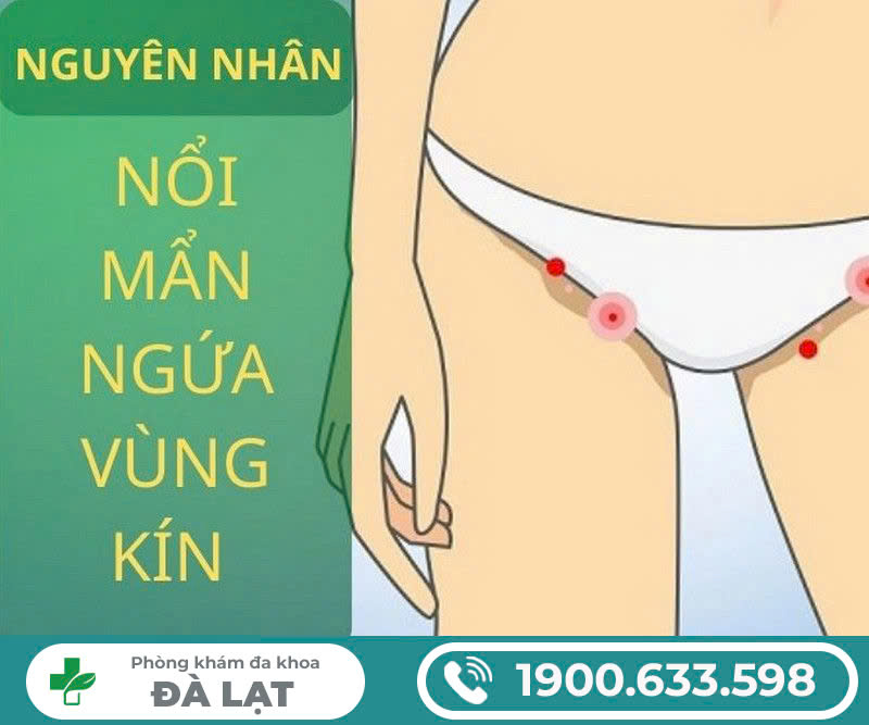 Vùng kín bị nổi mẩn đỏ: Nguyên nhân, biểu hiện và cách điều trị