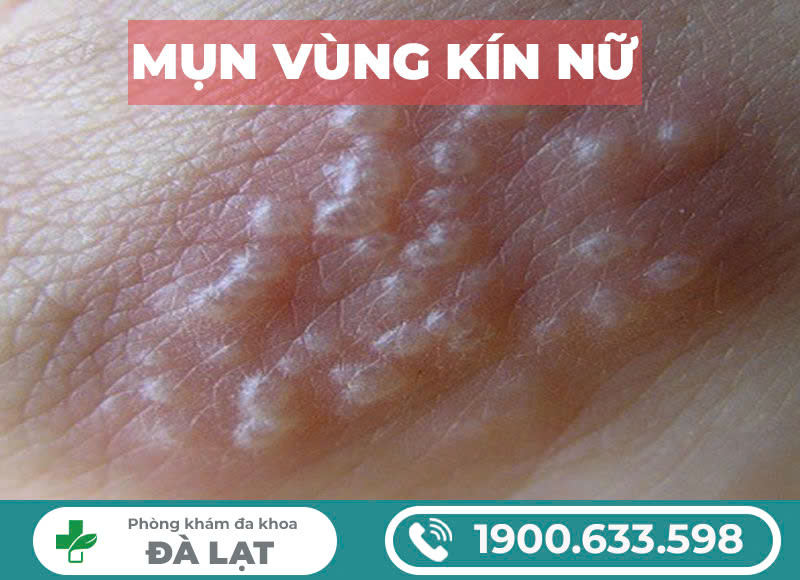 Mọc mụn bọc ở cô bé cảnh báo bệnh gì?