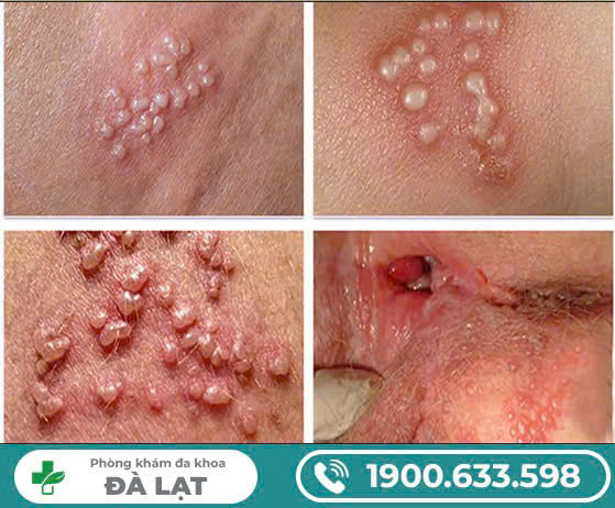 Bệnh lây qua đường tình dục/bệnh STDS ? Phương pháp điều trị hiệu quả nhất ?