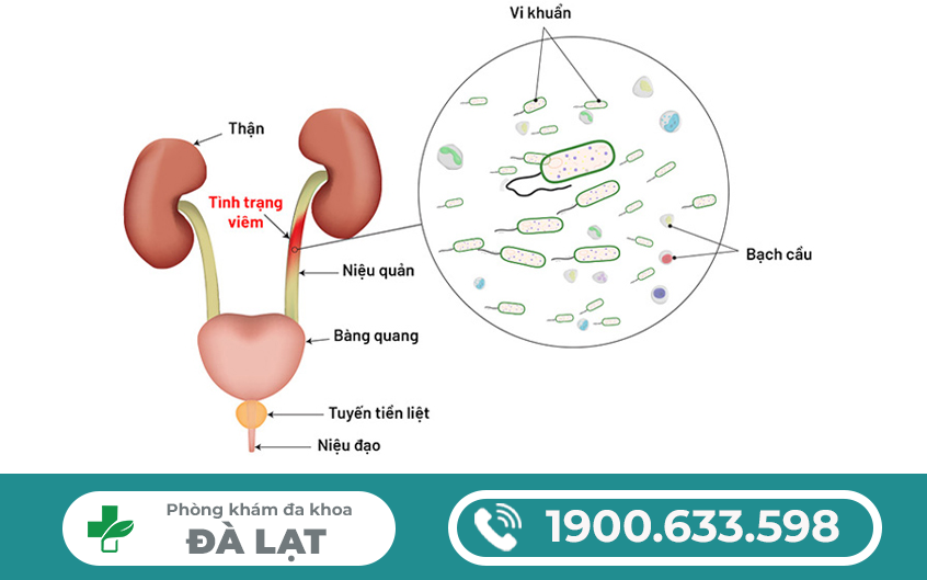 Viêm đường tiết niệu là bệnh gì và có nguy hiểm không?