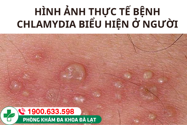 Bệnh chlamydia ở nam & nữ giới? Phương pháp điều trị hiệu quả nhất 2025!