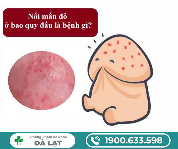 Nổi Mẩn Đỏ Ở Đầu Khấc: Nguyên Nhân, Triệu Chứng và Cách Điều Trị