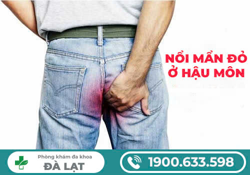 Nổi mẩn đỏ ở hậu môn nam giới - Nguyên nhân và cách điều trị hiệu quả