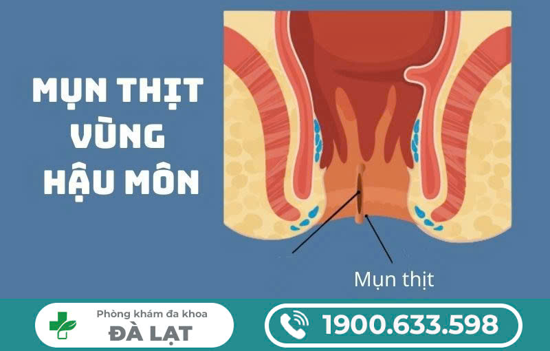 NỔI CỤC THỊT Ở HẬU MÔN LÀ BỆNH GÌ? CÓ NGUY HIỂM KHÔNG? 