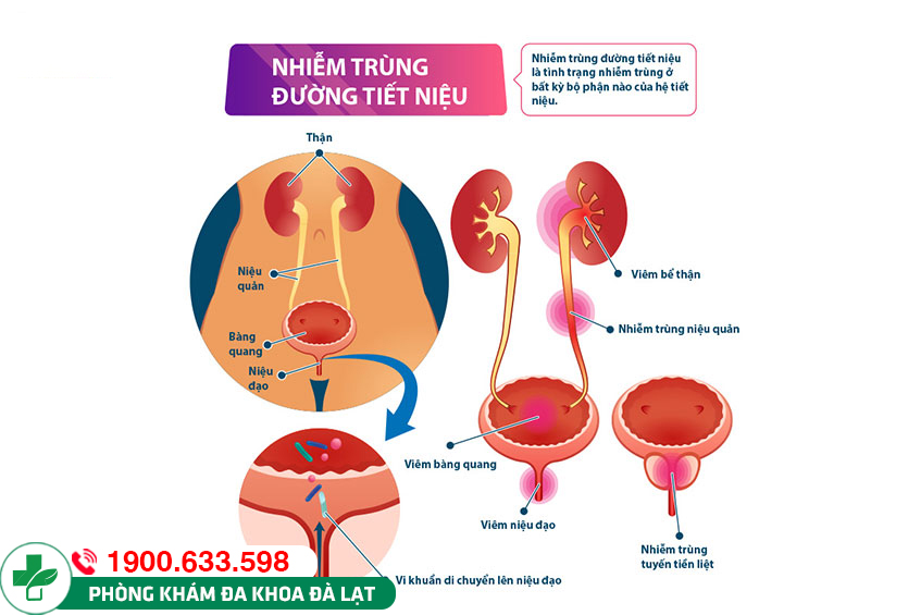 Triệu chứng viêm đường tiết niệu và cách điều trị