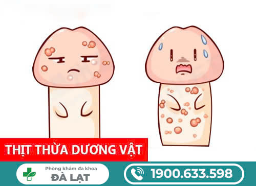 DƯƠNG VẬT NỔI CỤC THỊT THỪA - ĐÂY CÓ PHẢI BỆNH LÝ KHÔNG?