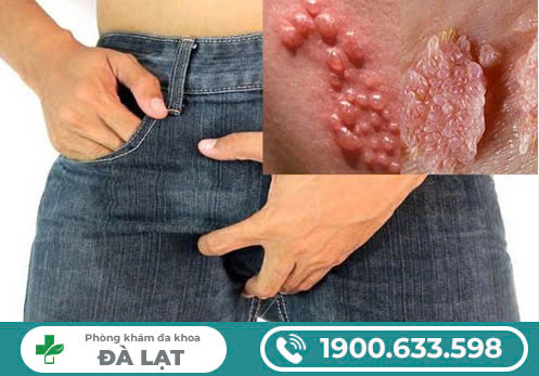 CÁCH CHỮA MỤN VÙNG KÍN NAM  GIỚI