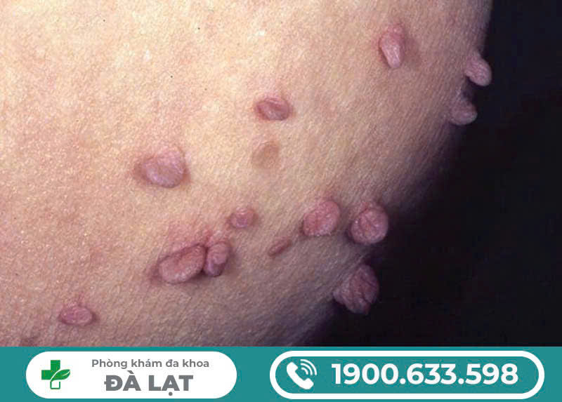 MỤN CÓC SINH DỤC MỌC Ở ĐÂU? PHƯƠNG PHÁP ĐIỀU TRỊ UY TÍN NHẤT?